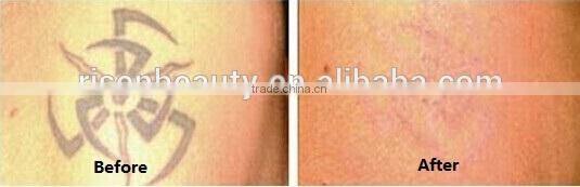 Best Price Q Switch Tattoo Removal laser for sale