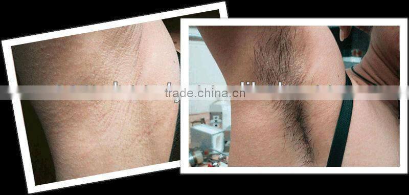 skin rejuvenation elight/ at home skin tightening machine C005