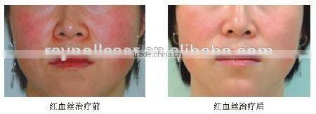 2015 Trading Products for Import 30.56MHz High Frequency RBS Spider Vein Removal Machine