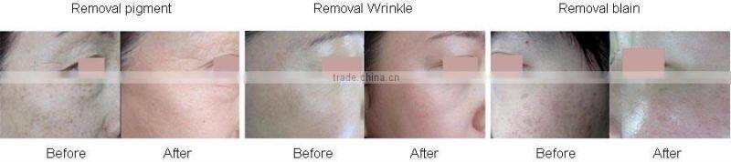 fractional co2 laser equipment/co2 fractional laser/fractional co2 laser