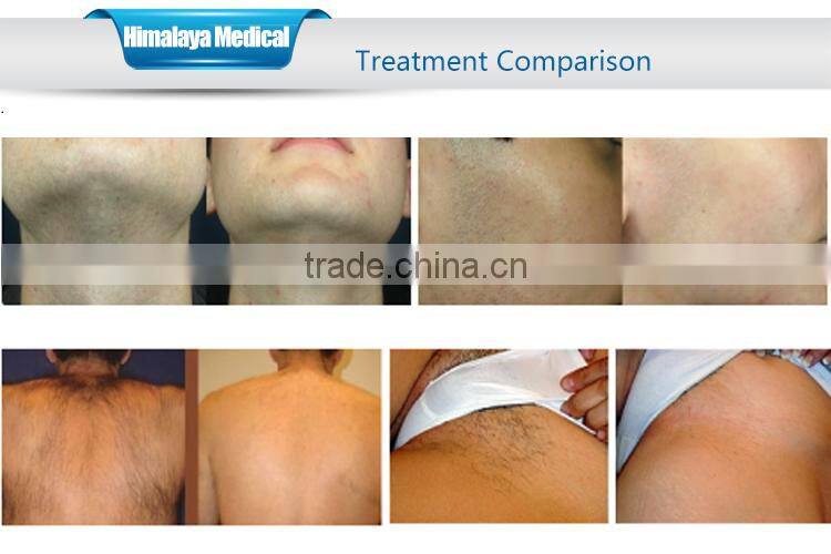 Medical CE approve SHR IPL hair removal permanent/SHR elight ipl hair removal machine