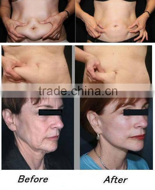 Coolipo V9 Cavitation Machine