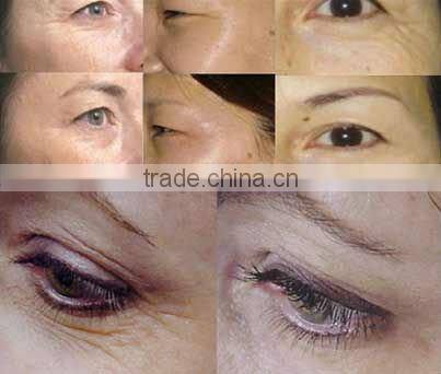 best pride for 200 needles derma roller with replacable head for skin cure