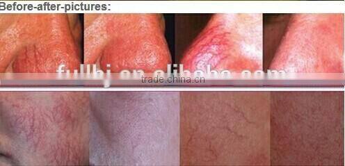 Vein killer!!! Magical laser varicose vein removal treatment for sale