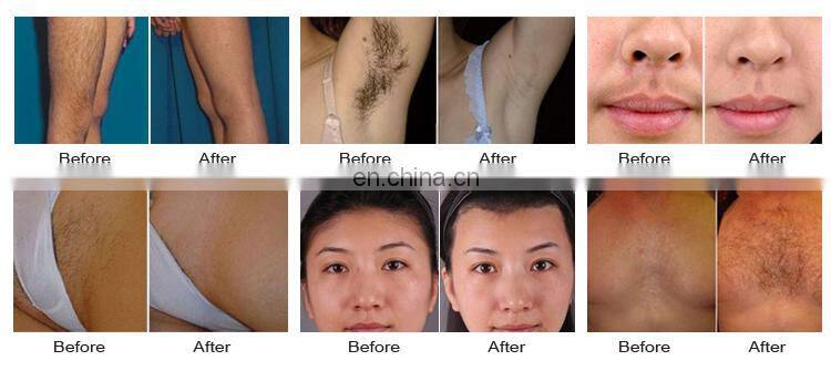 Newest Portable 808nm laser hair removal home from china