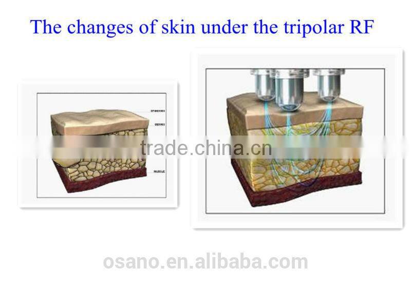 Hot sale 4 in 1 5MHZ Multipolar RF+Tripolar RF+Bipolar RF+Cavitation for home use LM-VR200