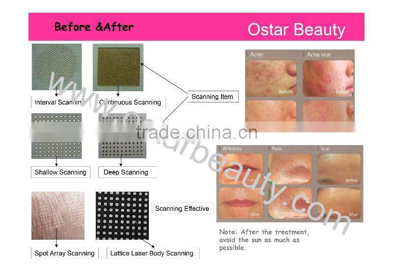 Porfessional CO2 fractional laser beauty machine skin care OB-FC 01