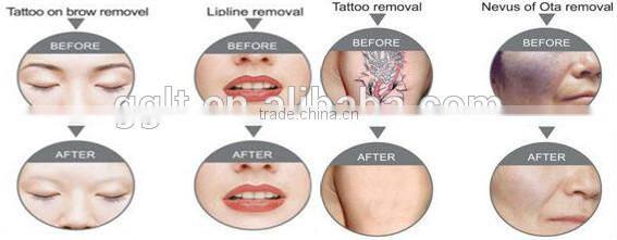 Portable 3 in 1 tattoo and hair removal ipl rf+nd yag laser multifunction machine