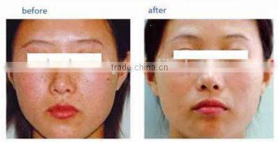 2015 New Design Q-Switch Laser Tattoo Removal Laser