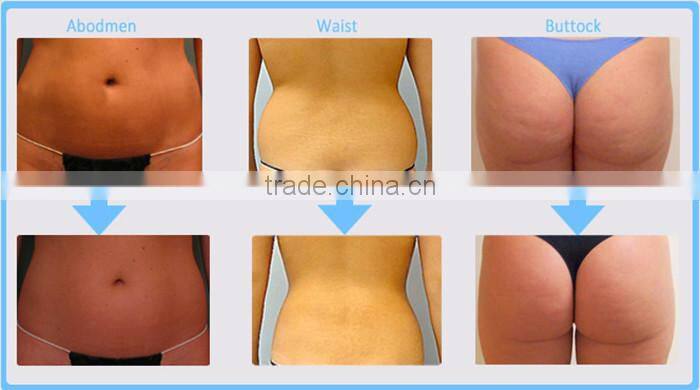 for sale one treatment 1 hour 1 size smaller U Shape HIFU machine CE
