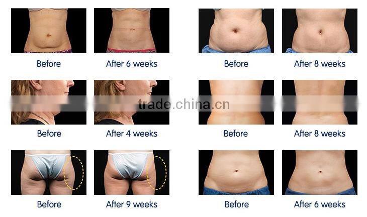 Micro machine cold body sculpting machine fat freezing cryolipolysis machine for home use