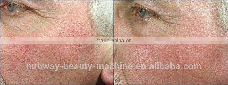 1800W Big Power 3 Functions Skin Tightening Blood Vessel Remove Laser Medical Beauty Equipment IPL Lamp