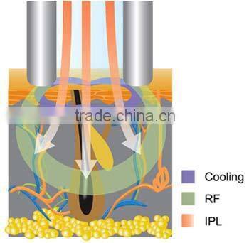 laser multifunction e-light+laser for hair removal and tatoo removal