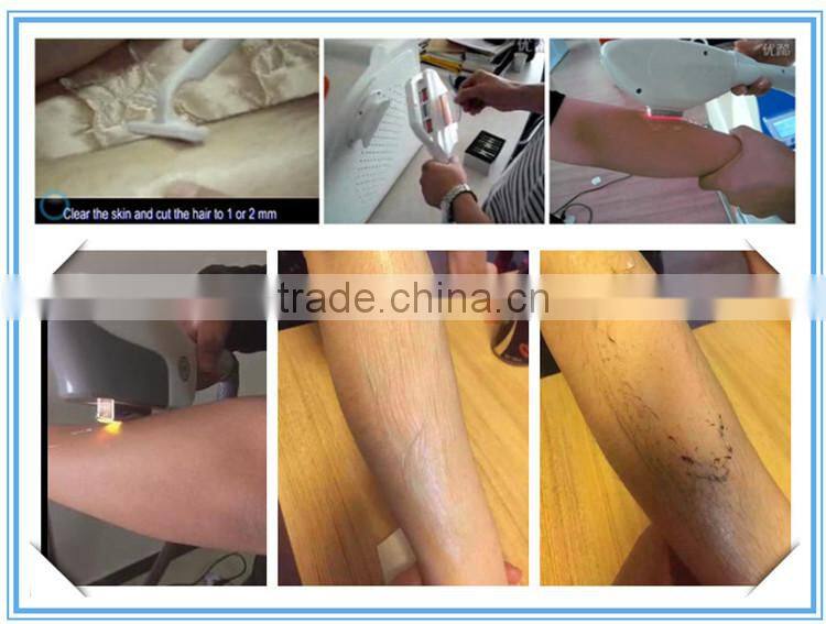 10 milliion shots lazer hair removal 808nme light laser hair removal machine