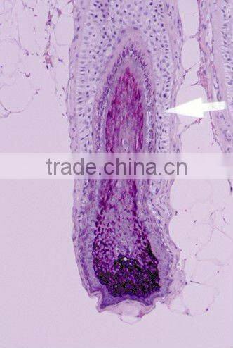 Diode Laser Hair Removal Machine