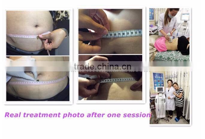 Newest technology liposonix for slimming machine