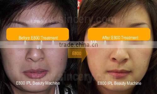 Vertical E-light IPL machine, skin photo aging treatments and hair removal german skin solution e-light