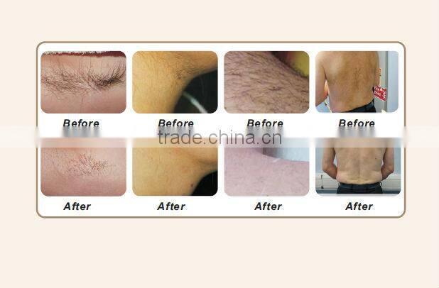 SHR high energy 808nm diode laser depilation