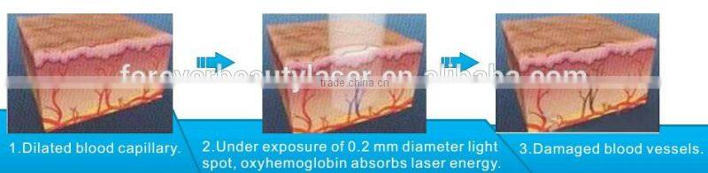 skin care therapy spider vein removal 980nm diode laser machine for vascular removal