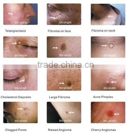 Spider Vein Removal machine Capillary Removal equipment