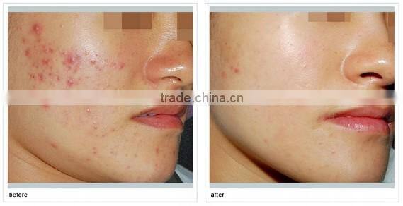 2016 Best Price PDT LED Machine