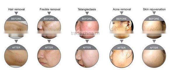 ipl beauty equipment skin care and hair removal (ipl rf machine)