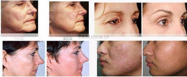 2014 professional radiofrequency micro needle rf fractional&fractional rf microneedle machine