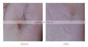 Health Care Beauty Equipment ipl rf filter 430 nd yag laser hair removal machin