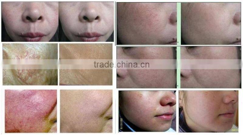 Promotion! high frequency electrocoagulator for treating spider veins