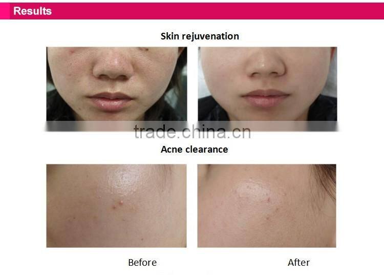 DEESS home use ipl permanent laser hair removal device