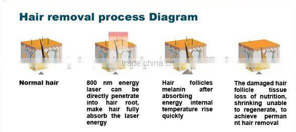 Newest mode portable diode laser hair removal professional 808nm diode laser hair removal machine
