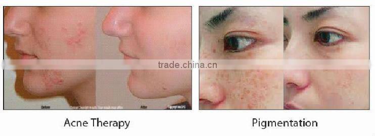 IPL+RF beauty equipment for hair removal,beauty equipment