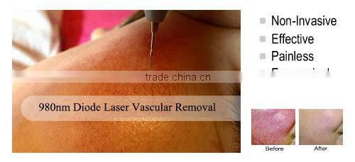 New 980nm RBS Vascular Therapy Red Spider Veins Removal Machine