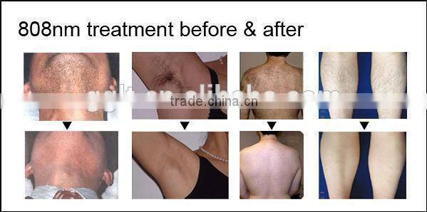808nm diode laser fast hair removal medical beauty machine