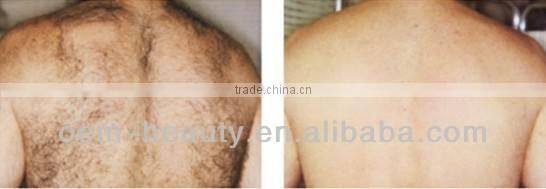 Most effective elight ipl rf laser hair removal and skin rejuvenation equipment