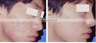 High Power Manufacture Supplied E-light IPL/RF Hair Removal Machine
