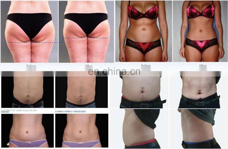 Smart abdominal muscle stimulator training ems abs electric muscle stimulation anti-cellulite belly slimming machine