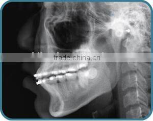 China Cheap Dental Panoramic and Cephalometric X-ray Machine