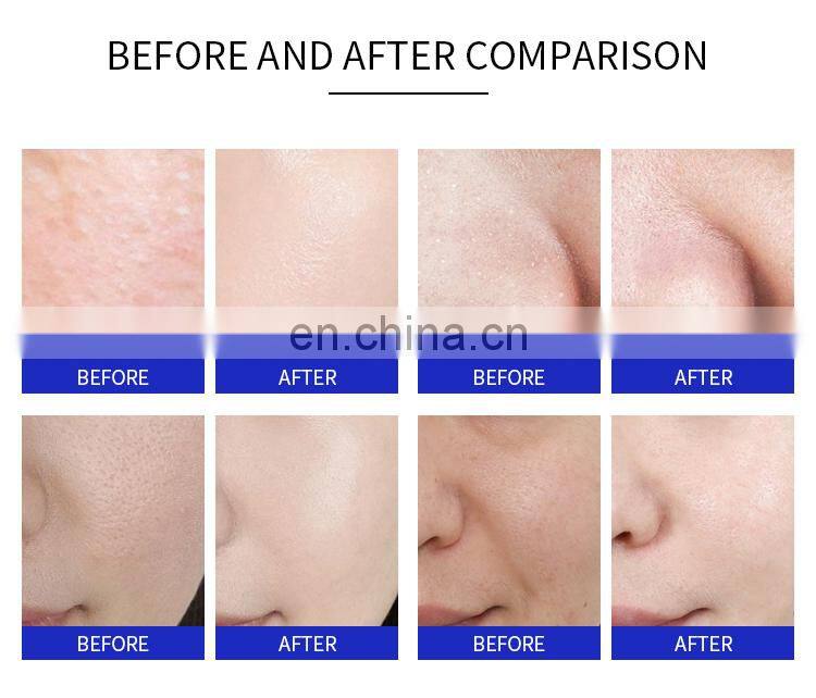 3 In1 Diamond Microdermabrasion Hydra Beauty Machine Facial Peeling Suction Oxygen Jet Skin Rejuvenation Dermabrasion Instrument