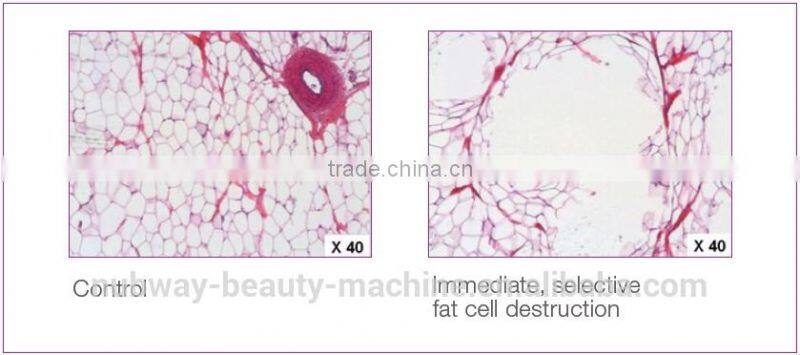 Chinese Unique Design High Intense Focus Ultrasound Hifu For Slimming