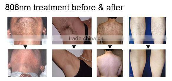 Professional sapphire laser 808nm diode laser hair removal device