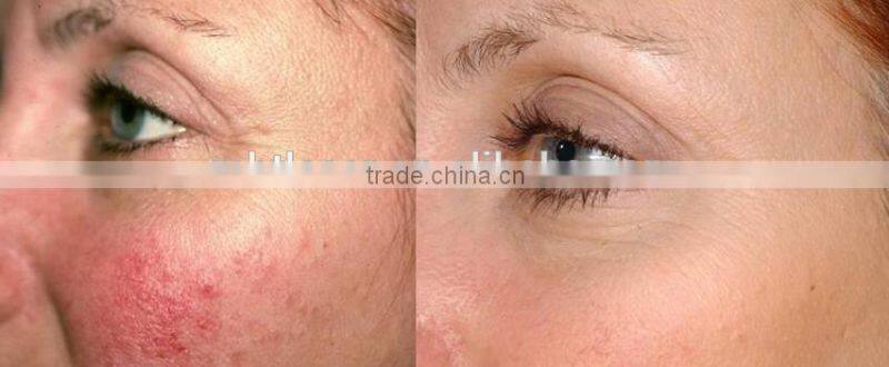 MBT 980nm diode laser for vascular lesions and spider veins machine