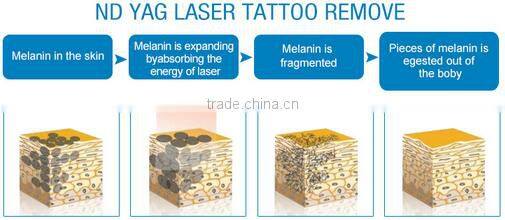 2016 china laser beauty equipment Q-switched nd yag laser tattoo removal 1320nm black doll for salon use