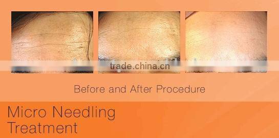 Fine titanium acupuncture needle derma meso roller