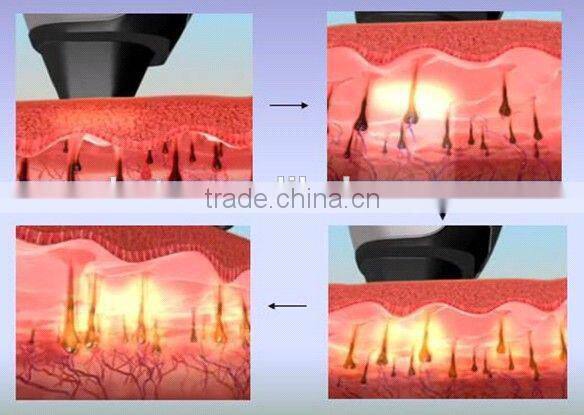 Guangzhou HETA Cavitation RF radio frequency cellulite reduction beauty machine