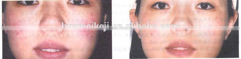 Permanent hair removal machine IP portable IPL for hair removal skin rejuvenation, acne removal