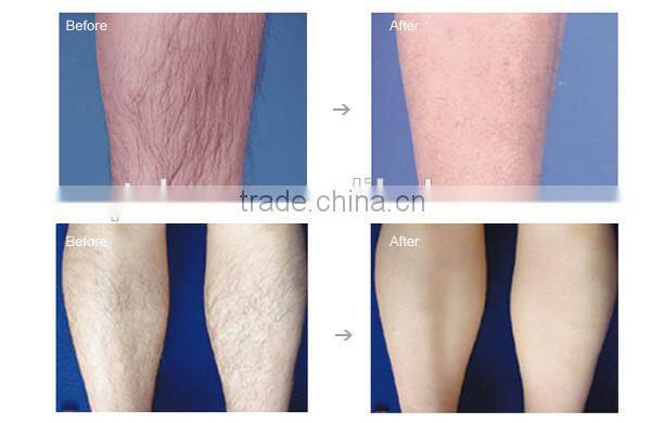 Hair removal machine--755nm Alexandrite laser and Long Pulse, two in one