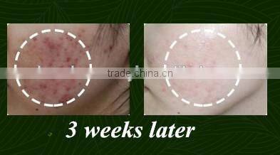 VITAMIN C Whitening Anti-Acne Treatment Face Cream 50 g