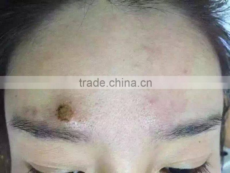 2015 New Wholesale Professional mini Tatoo Spot Mole Laser Remover freck spot removal laser pen