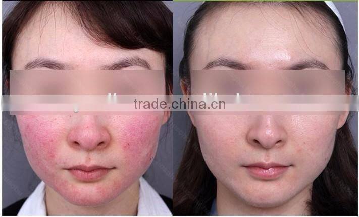 2016 Laser Diode 980nm Permanent Vascular Removal Rosacea Treatment Machine